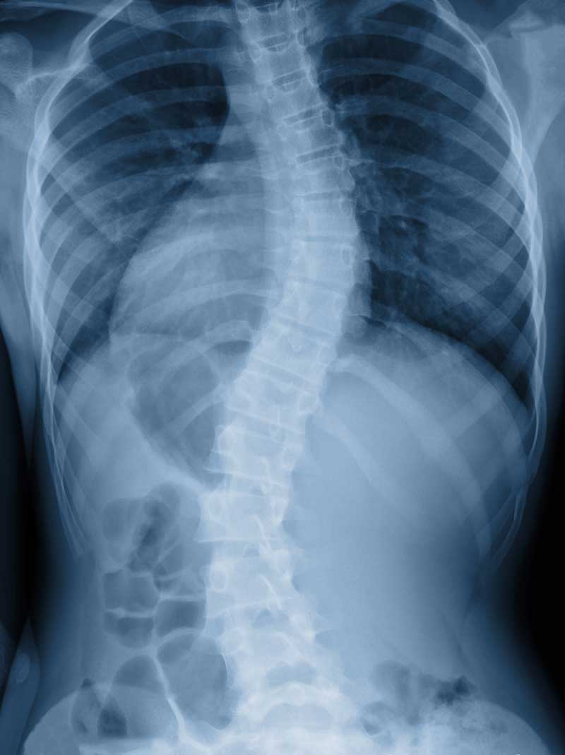 Scoliosis  Alameda, CA 